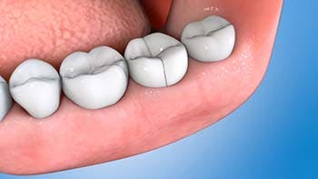 D2.1 Fractured Tooth