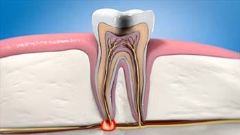 B7.2Rootcanaltherapy Still2